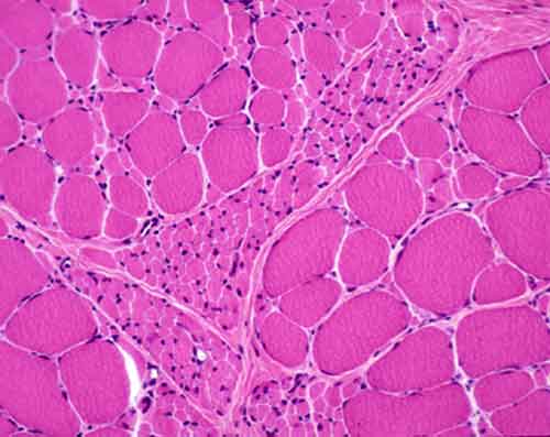 atrofia.jpg atrofia.jpg